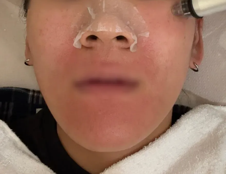 라라필 산소필 아쿠아필 비교: 모공·피지·건조 피부 타입별 필링 추천 — 사진 2