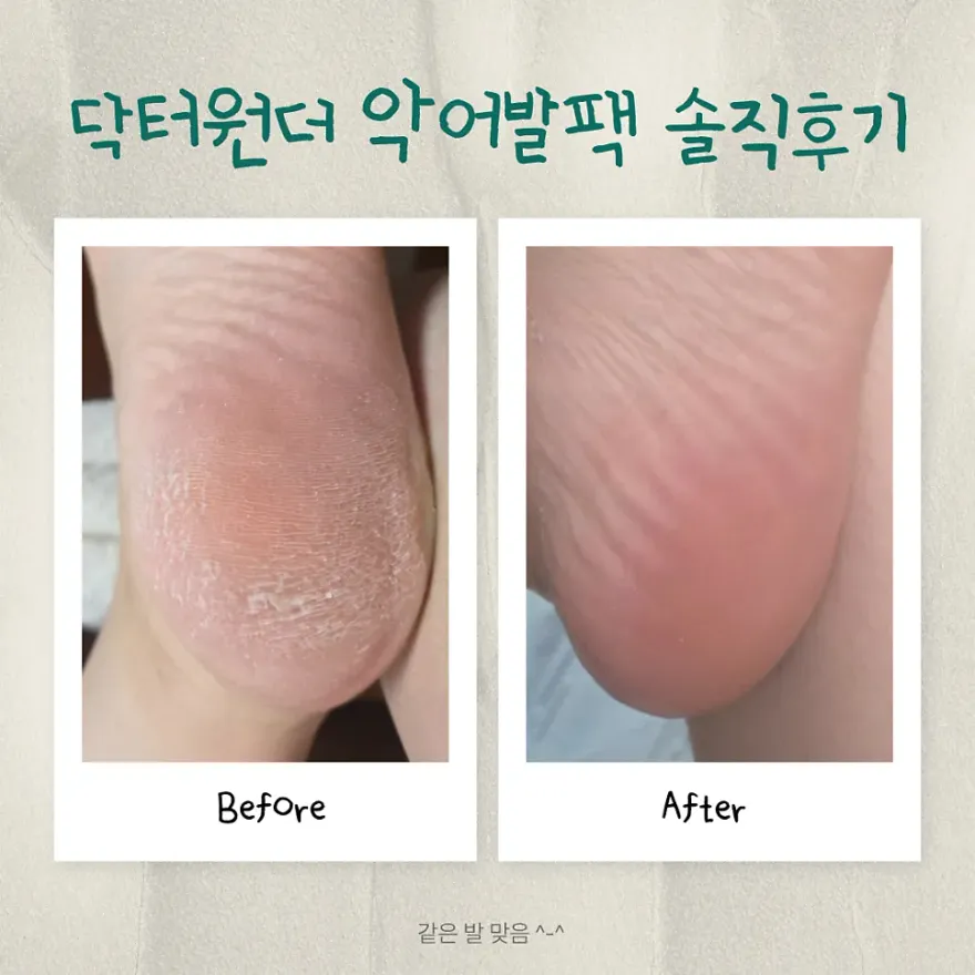  닥터원더 악어발팩 2달 사용 후기: 각질 제거 효과와 꿀팁