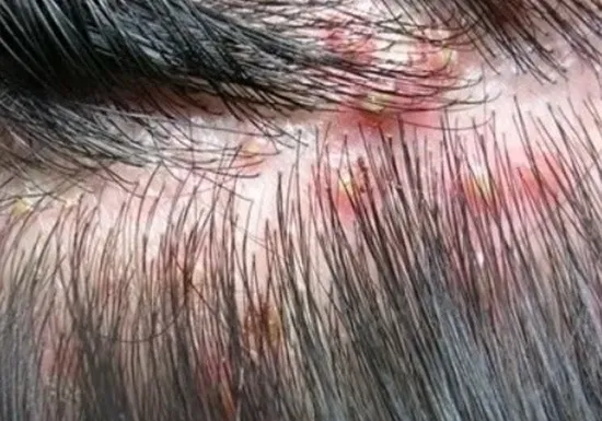  니조랄 샴푸 약용샴푸 가려운 지루성두피염 비듬샴푸 후기